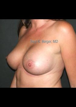 Breast Augmentation – Case 12