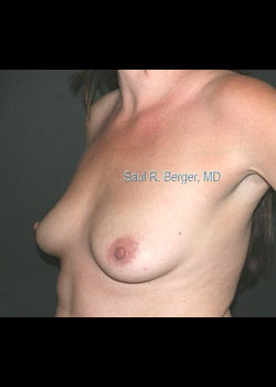 Breast Augmentation – Case 12