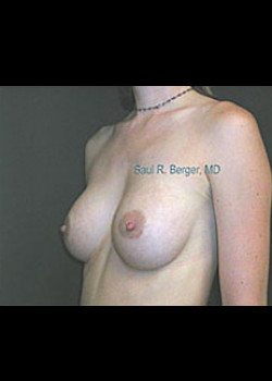 Breast Augmentation – Case 13