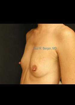 Breast Augmentation – Case 13