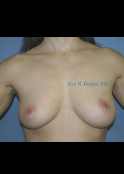 Breast Augmentation – Case 14