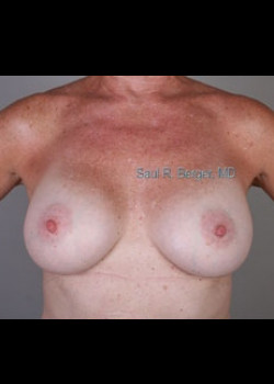 Breast Augmentation – Case 15