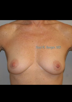 Breast Augmentation – Case 15
