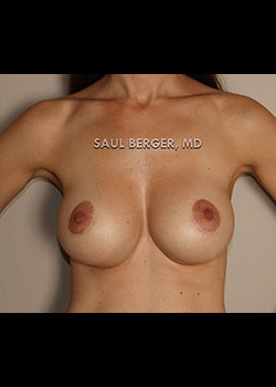 Breast Augmentation With Lift – Case 1