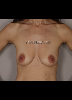 Breast Augmentation With Lift – Case 1