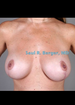 Breast Augmentation With Lift – Case 2