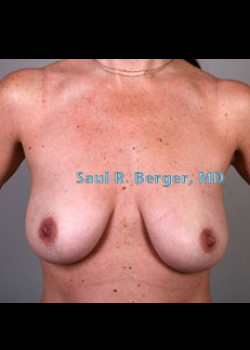 Breast Augmentation With Lift – Case 2