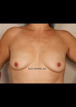 Breast Augmentation With Lift – Case 3