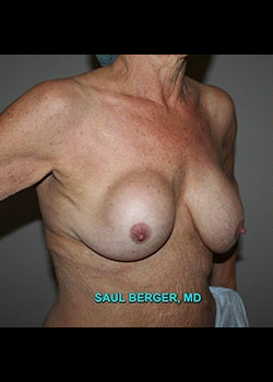 Breast Implant Revision – Case 1