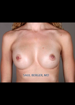 Breast Implant Revision – Case 2
