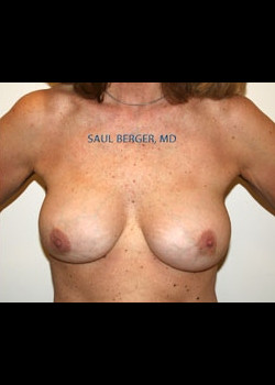 Breast Implant Revision – Case 3