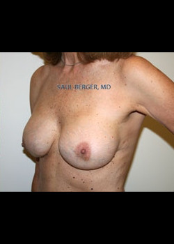 Breast Implant Revision – Case 3