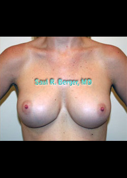 Breast Implant Revision – Case 4