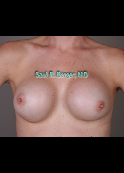 Breast Implant Revision – Case 4