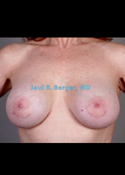 Breast Implant Revision – Case 5
