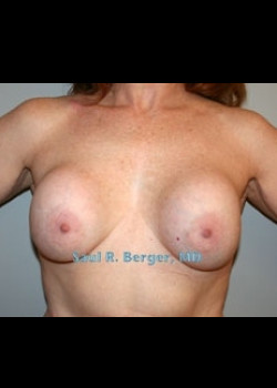 Breast Implant Revision – Case 5