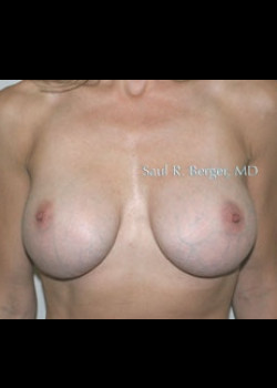 Breast Implant Revision – Case 6