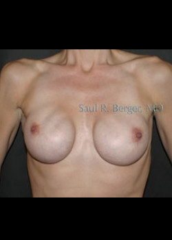 Breast Implant Revision – Case 6