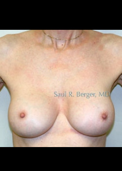 Breast Implant Revision – Case 7