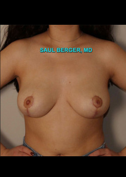 Breast Lift – Case 1