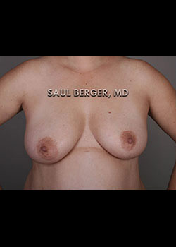 Breast Lift – Case 2