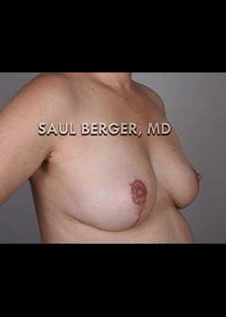 Breast Lift – Case 2
