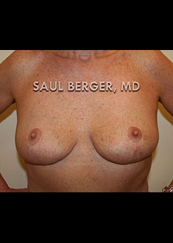 Breast Lift – Case 3
