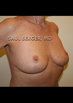 Breast Lift – Case 3