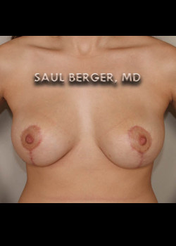 Breast Lift – Case 4