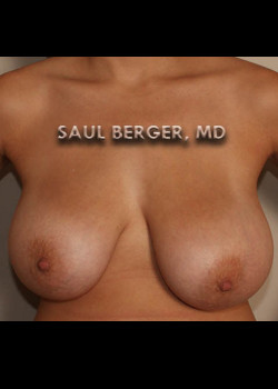 Breast Lift – Case 4