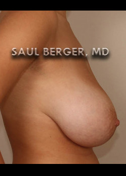 Breast Lift – Case 4
