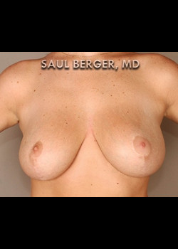 Breast Lift – Case 5