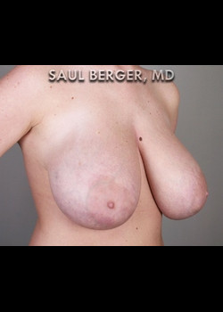 Breast Lift – Case 5
