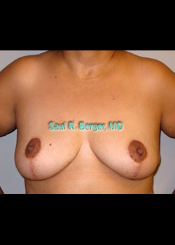 Breast Lift – Case 6