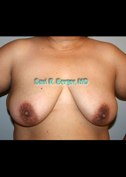 Breast Lift – Case 6