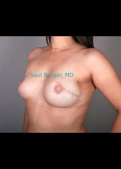 Breast Reconstruction – Case 2