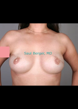 Breast Reconstruction – Case 2