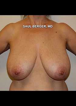 Breast Reduction – Case 2