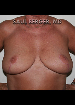 Breast Reduction – Case 3
