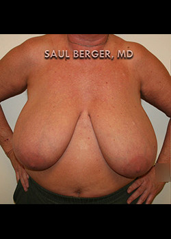 Breast Reduction – Case 3