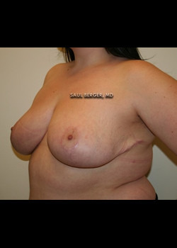 Breast Reduction – Case 5