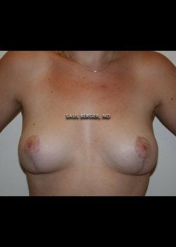 Breast Reduction – Case 6