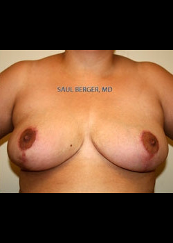 Breast Reduction – Case 7