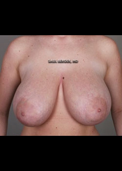 Breast Reduction – Case 8