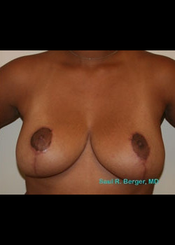 Breast Reduction – Case 10