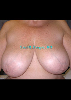 Breast Reduction – Case 11