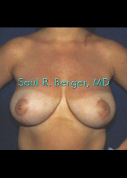 Breast Reduction – Case 12