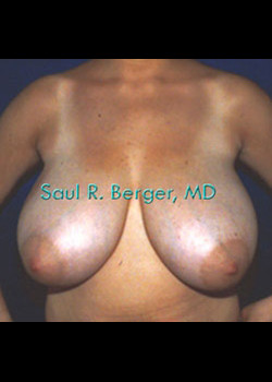 Breast Reduction – Case 12