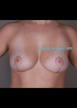 Breast Reduction – Case 13