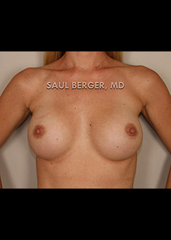Nipple Inversion/Projection Correction – Case 1
